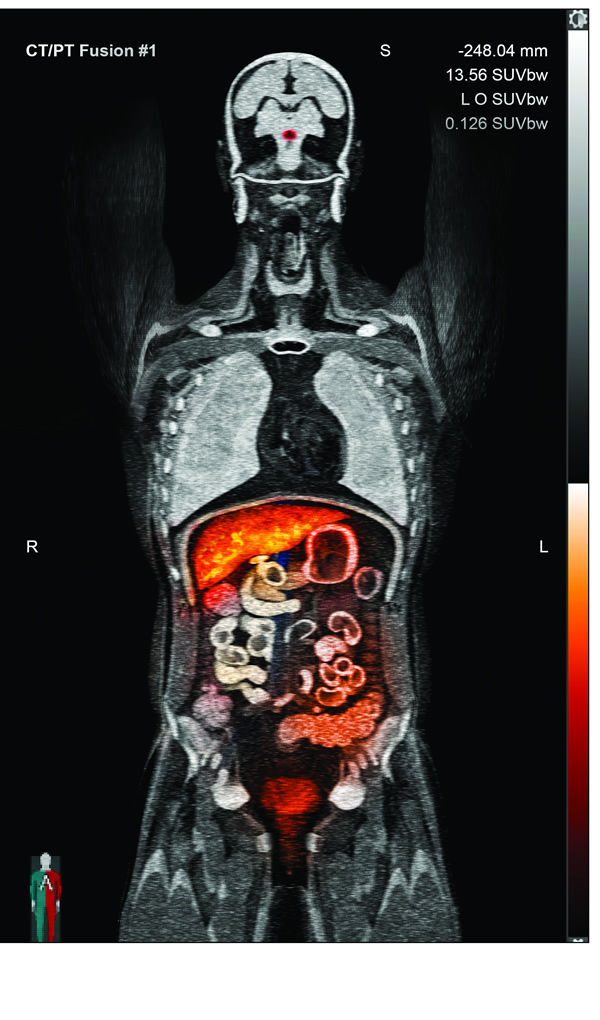 The PRRT method uses an image produced by co-registering two images: A CT scan and a PET scan performed with a newly approved tracer, Gallium-68 DOTATATE.