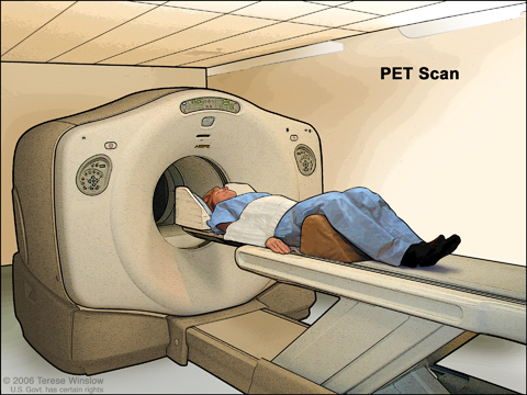 PET (positron emission tomography) scan. The patient lies on a table that slides through the PET machine. The head rest and white strap help the patient lie still. A small amount of radioactive glucose (sugar) is injected into the patient's vein, and a scanner makes a picture of where the glucose is being used in the body. Cancer cells show up brighter in the picture because they take up more glucose than normal cells do.