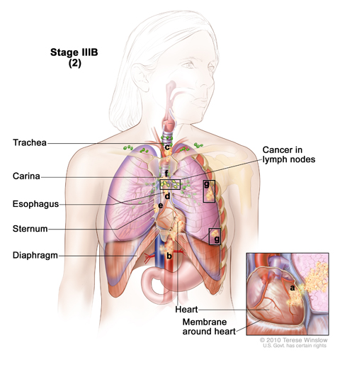 Cancer has spread to certain lymph nodes on the same side of the chest as the primary tumor and to (a) the heart; (b) major blood vessels that lead to or from the heart; (c) trachea; (d) esophagus; (e) sternum; and/or (f) carina; and/or (g) there may be separate tumors in different lobes of the same lung. Cancer may have spread to the backbone and/or the nerve that controls the larynx (not shown).