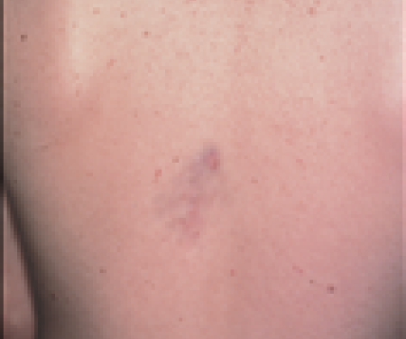 A closeup photo of a person's back, showing a palm sized purple dermatofibrosarcoma protuberan in the center of it.